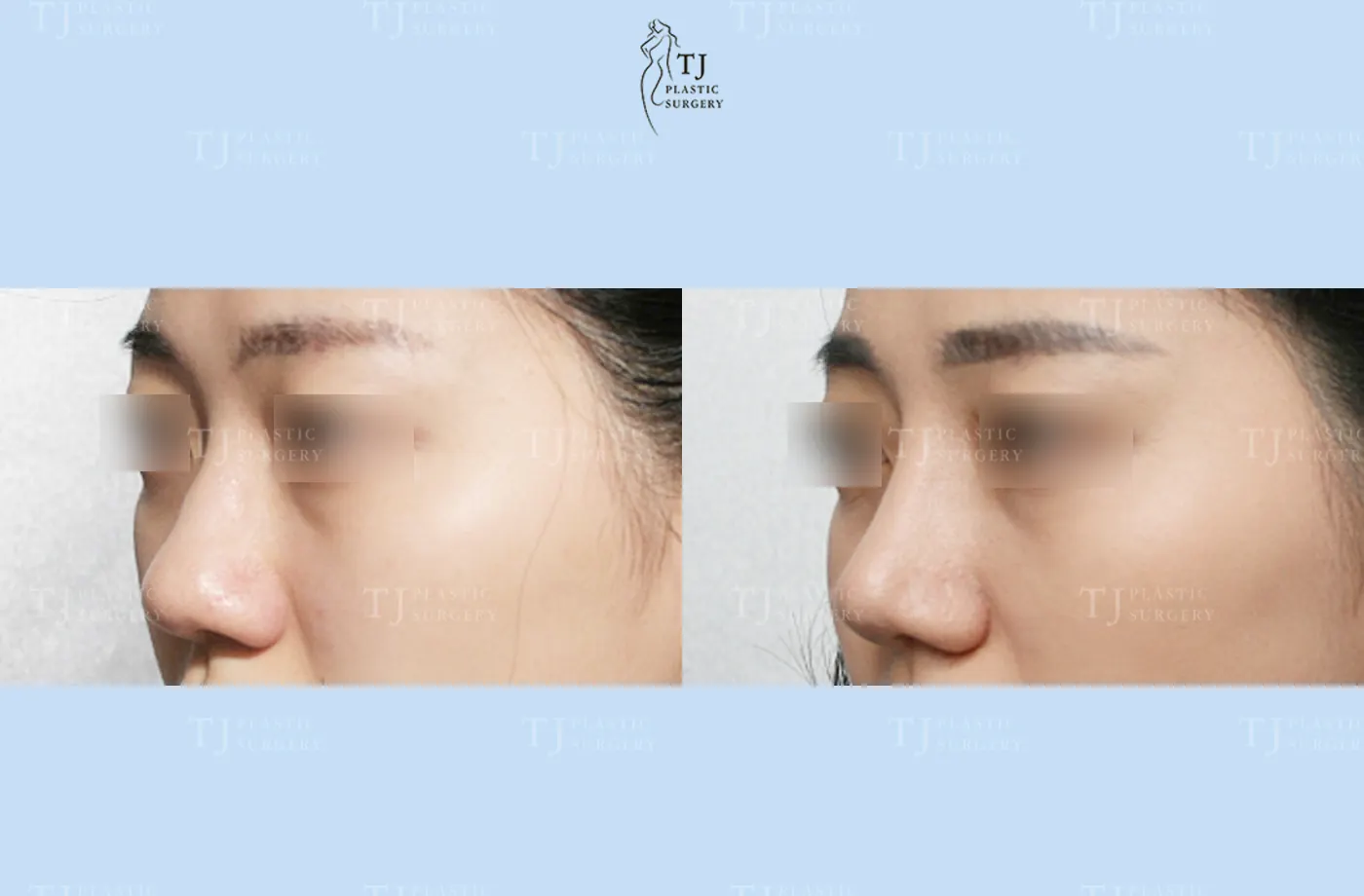 Rhinoplasty at TJ Plastic Surgery Clinic — Side view; before on the left · after on the right