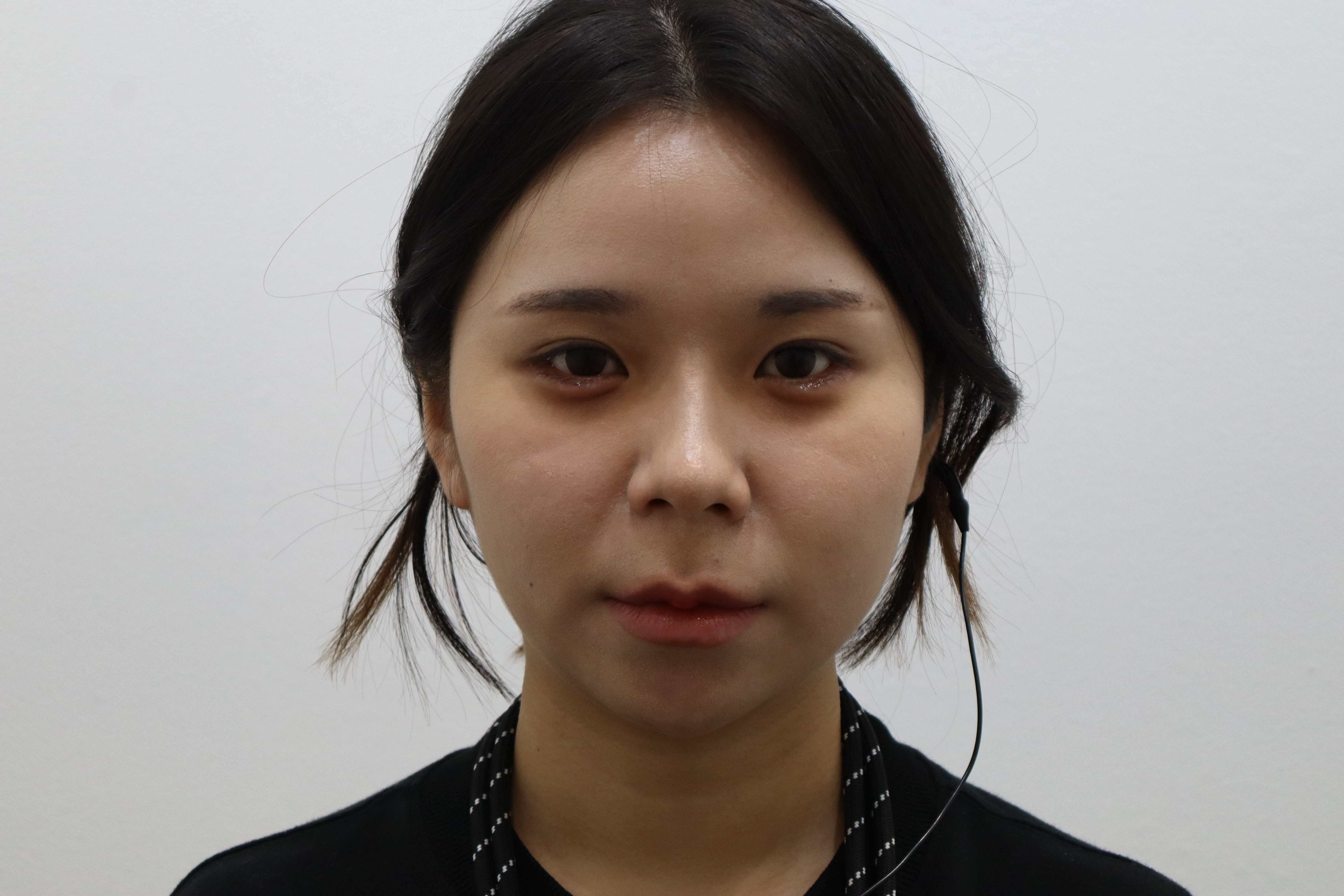 Aegyo-sal filler: treatment-day comparison before and after at Toxnfill Hongdae