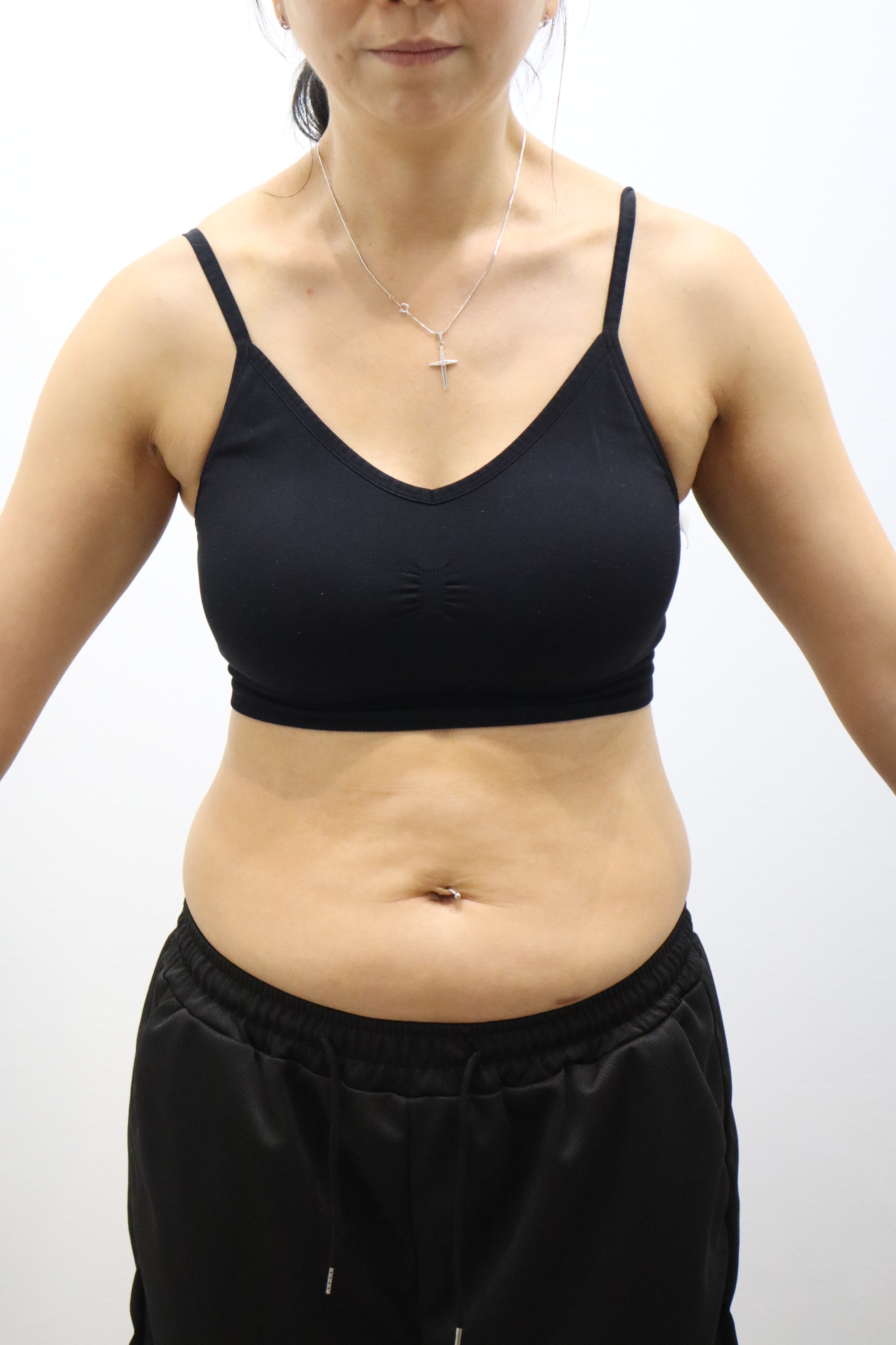 Body Onda with abdominal fat-dissolving injections before and after at Toxnfill Hongdae