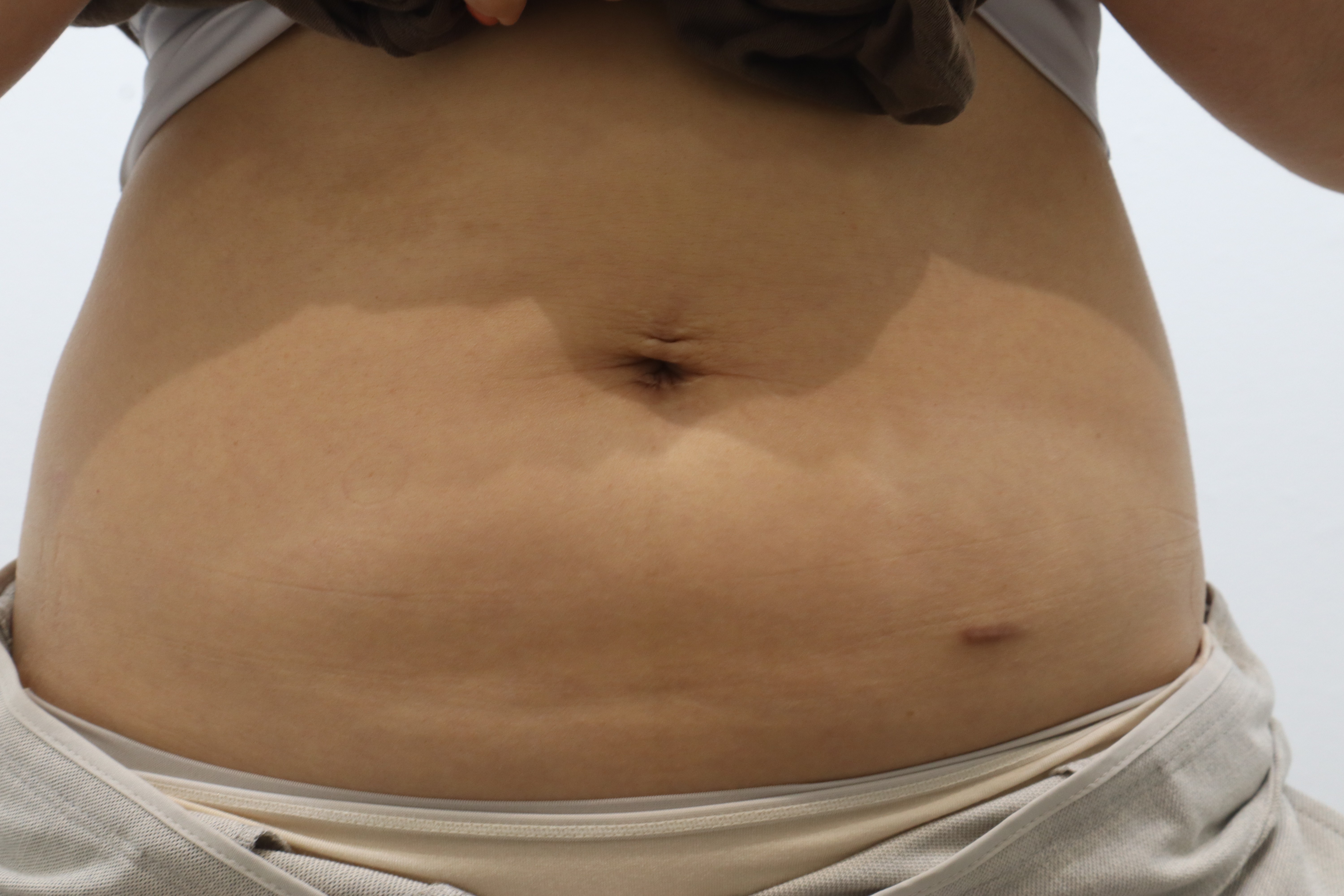 Body Onda with abdominal fat-dissolving injections at Toxnfill Hongdae: one-month follow-up, front view, August 15, 2026