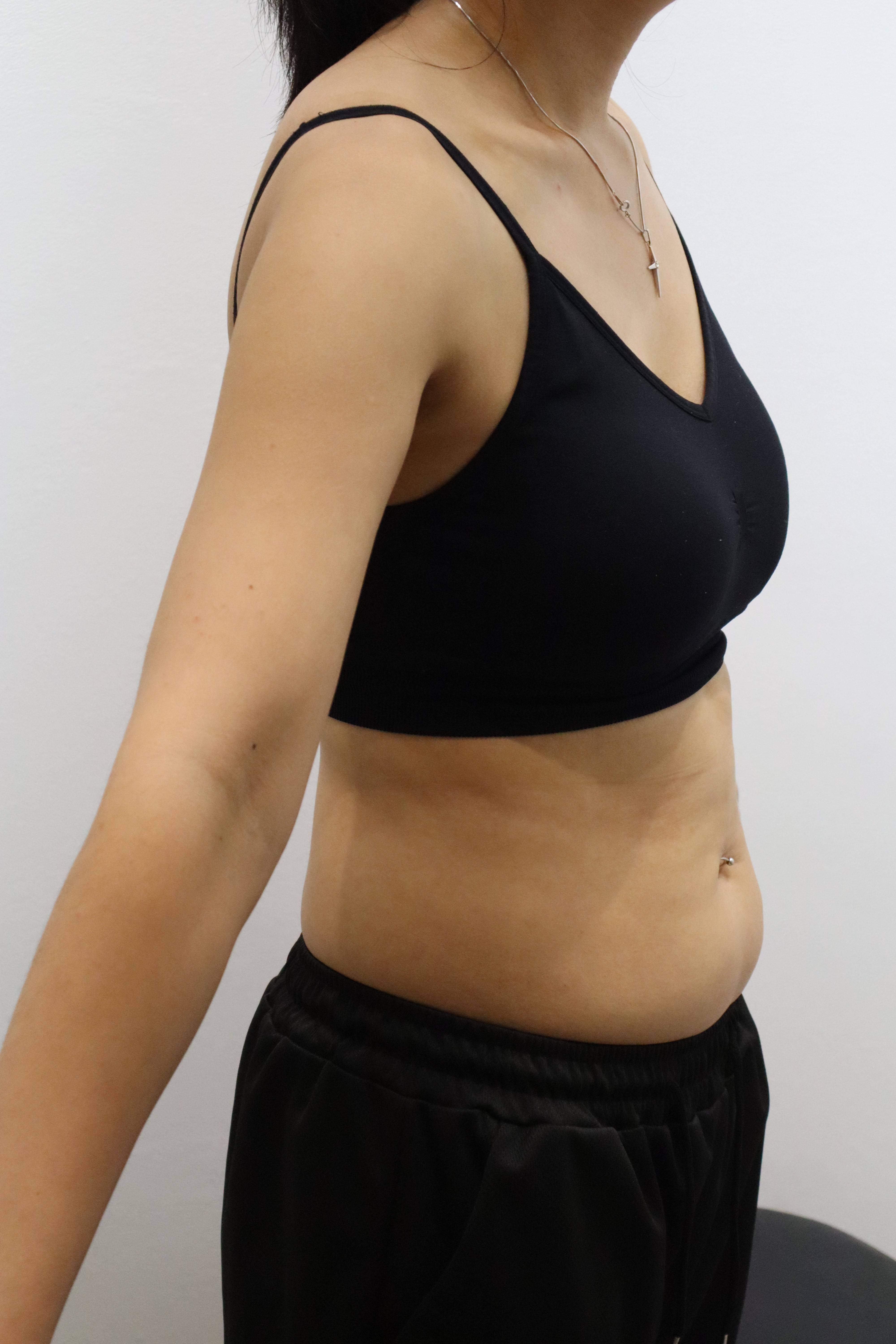 Body Onda with abdominal fat-dissolving injections at Toxnfill Hongdae: before, side view, July 17, 2026