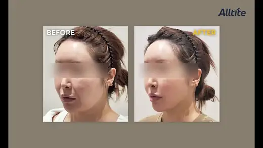 Alltite — cheek and jawline, one month before and after at Toxnfill Hongdae