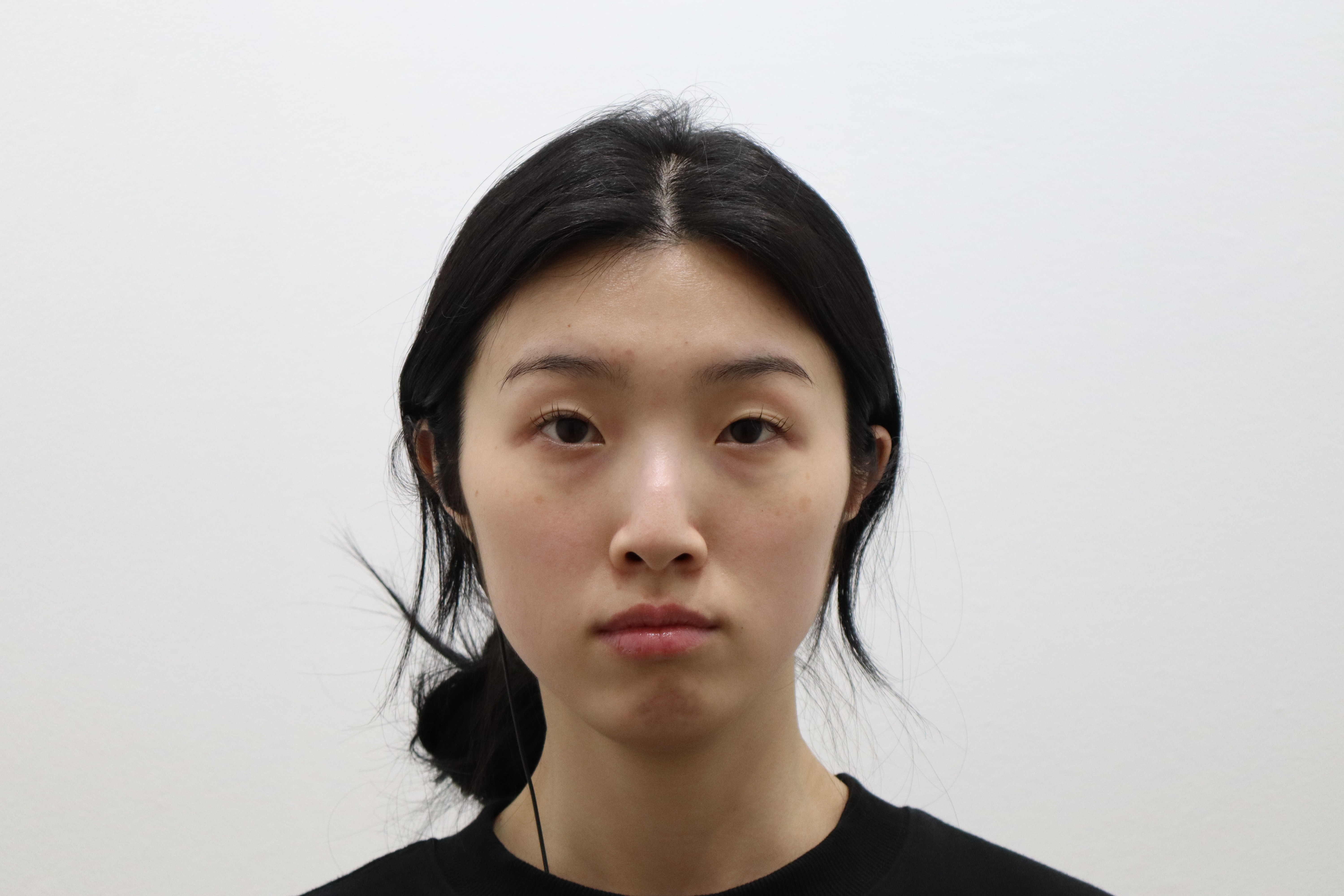 Cheek, under-eye and nasolabial filler: two-week follow-up before and after at Toxnfill Hongdae
