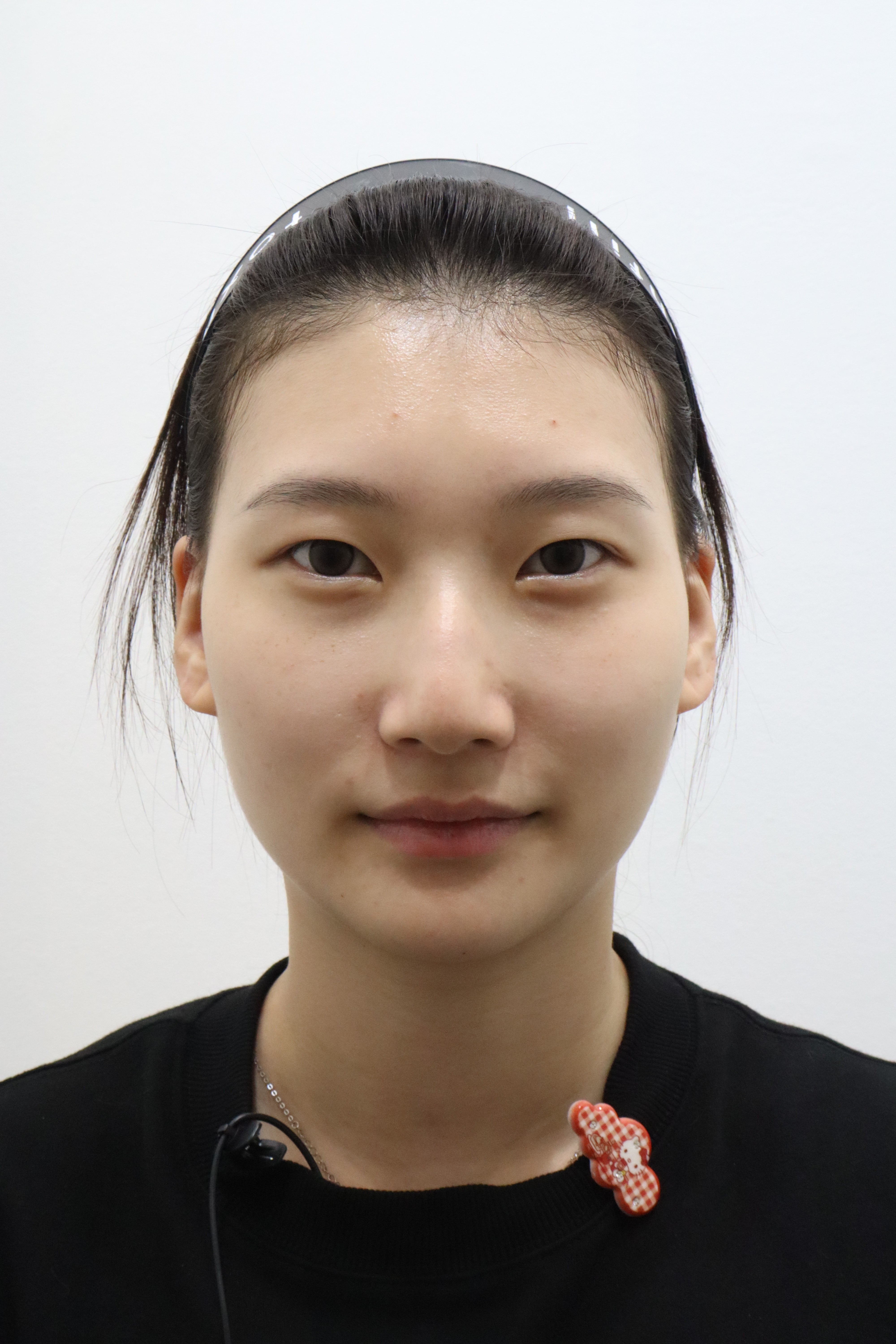 Freckle laser treatment: front and angled views before and after at Toxnfill Hongdae
