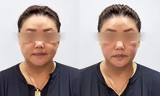 Alltite — front view, immediately after treatment before and after at Toxnfill Hongdae