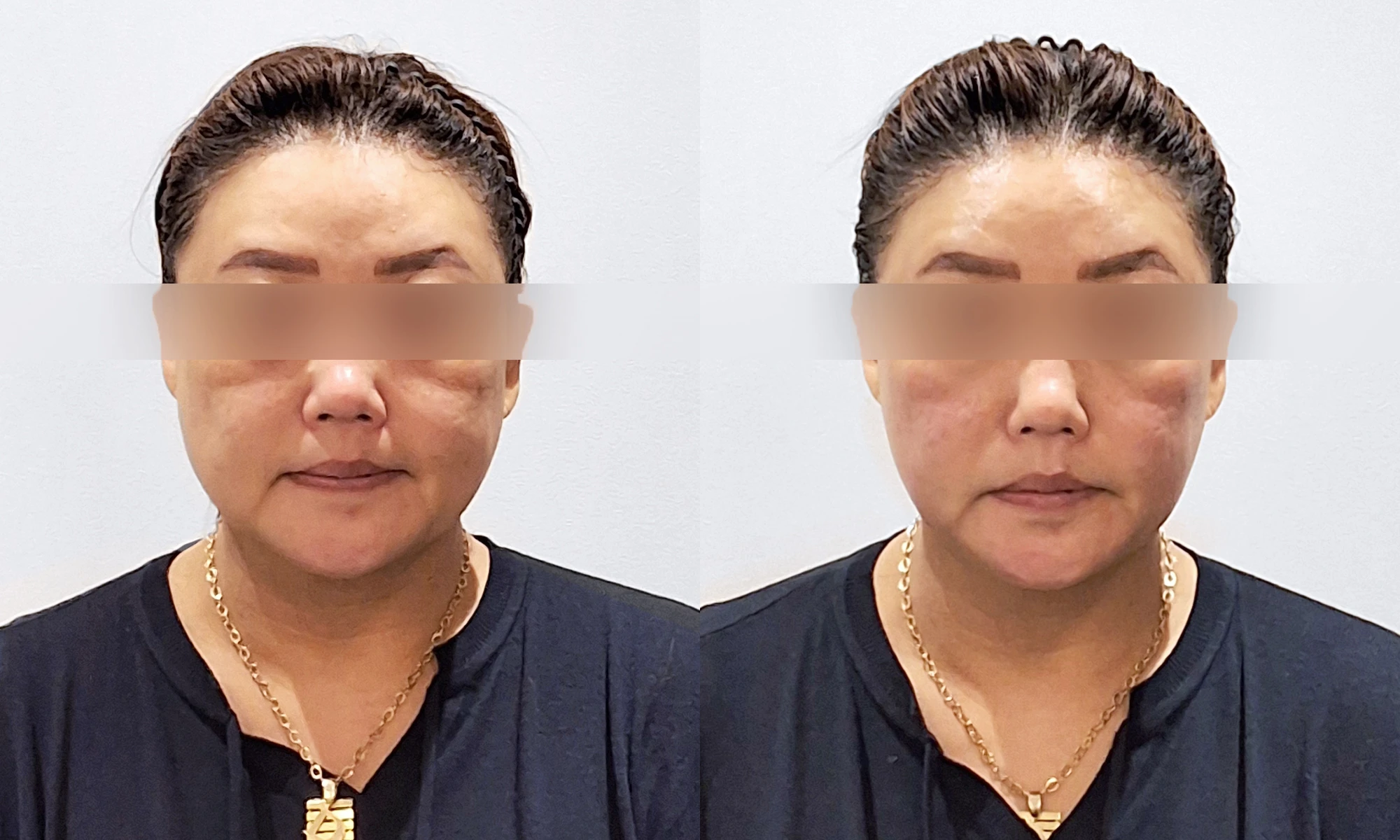 Alltite at Toxnfill Hongdae: front view, before on the left and immediately after treatment on the right