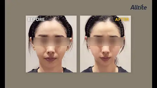 Alltite — front view, one month before and after at Toxnfill Hongdae