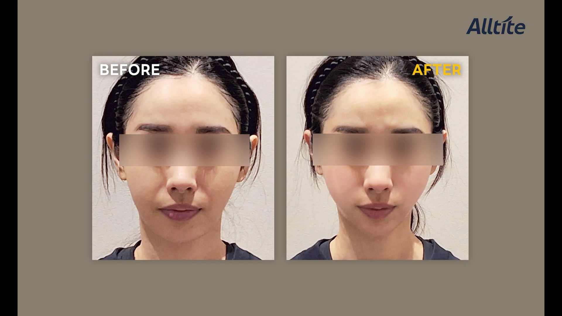 Alltite at Toxnfill Hongdae: front view, before on the left and one month on the right