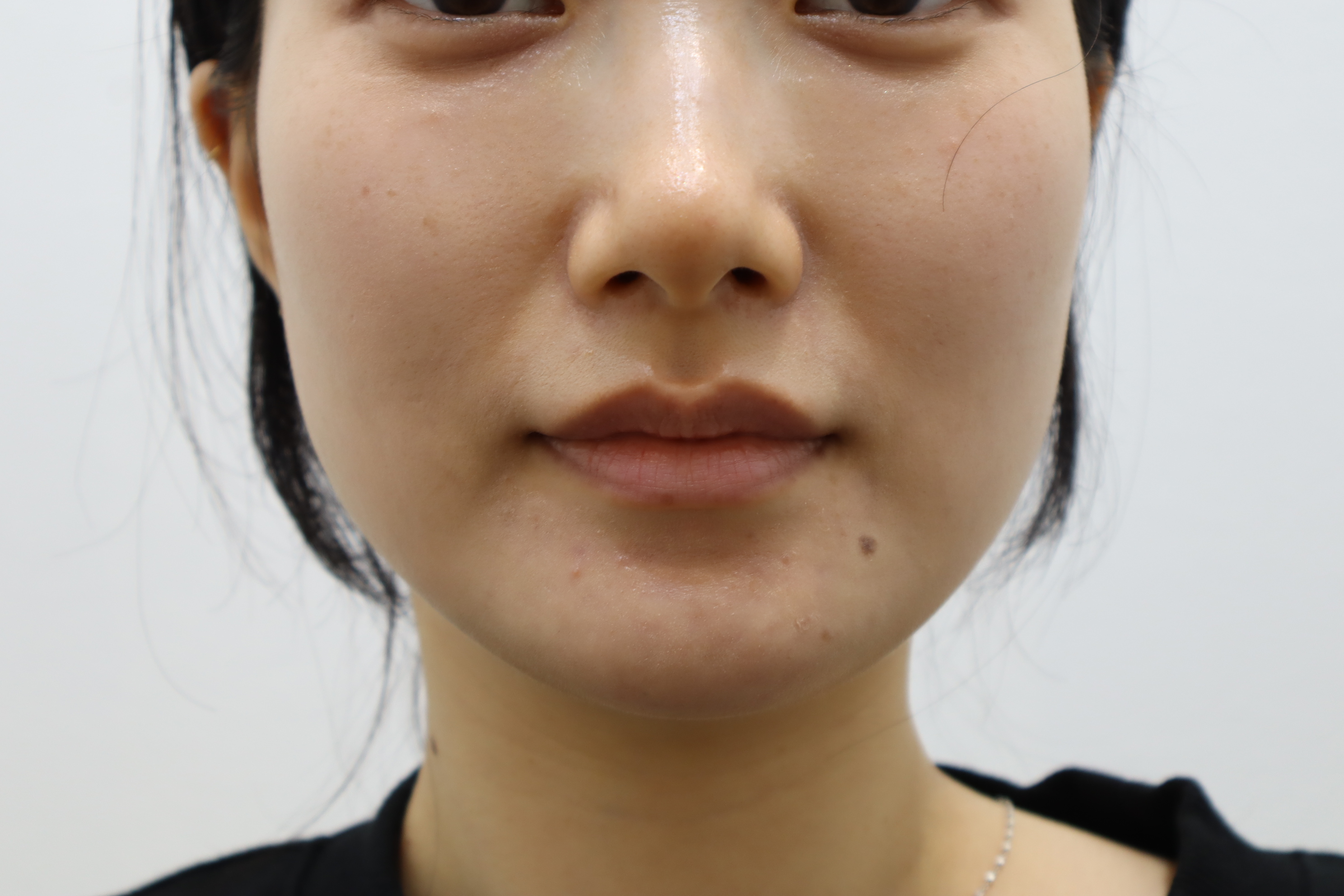 Lip filler: treatment-day photographs before and after at Toxnfill Hongdae