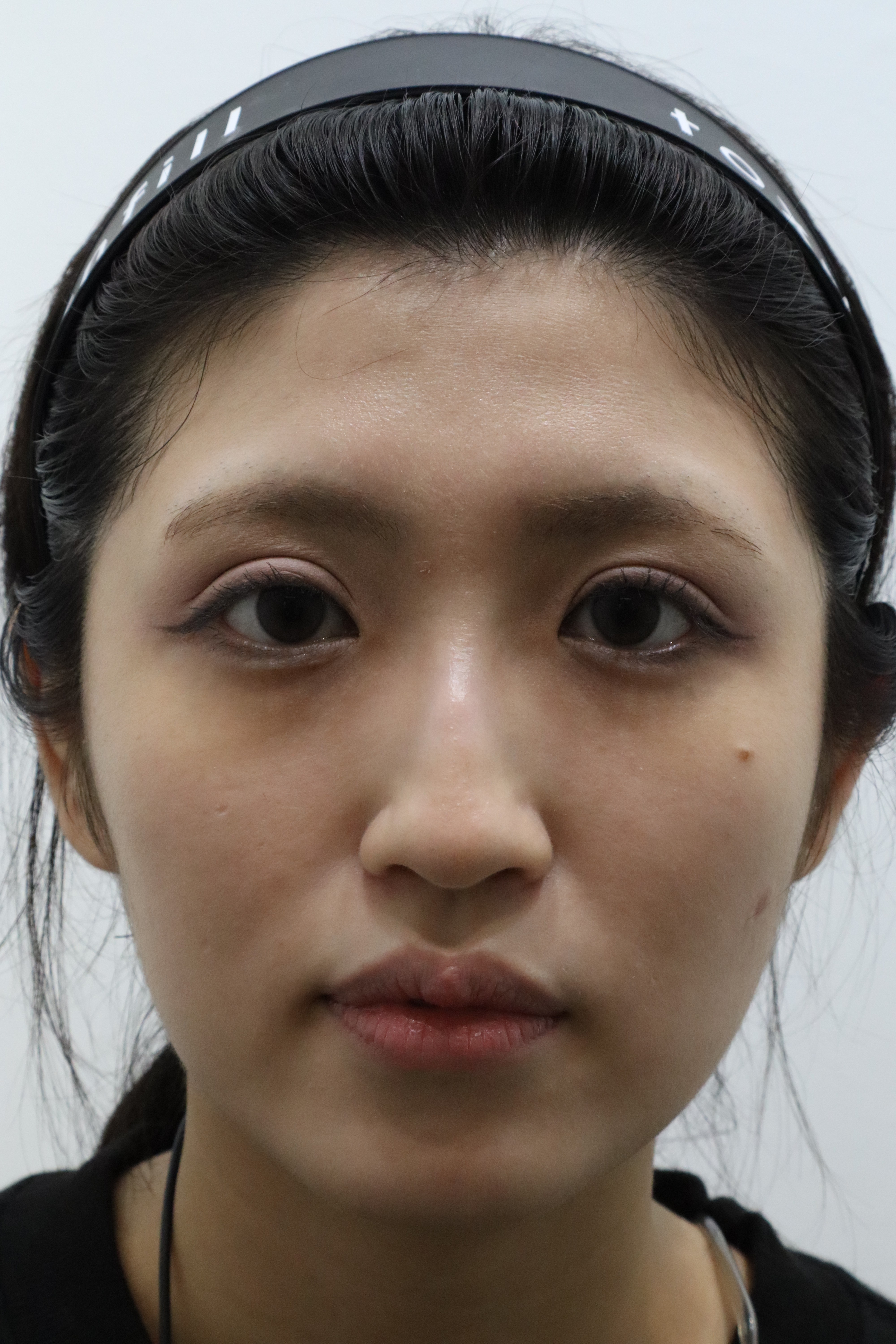 Nasolabial-fold filler: front and side views before and after at Toxnfill Hongdae