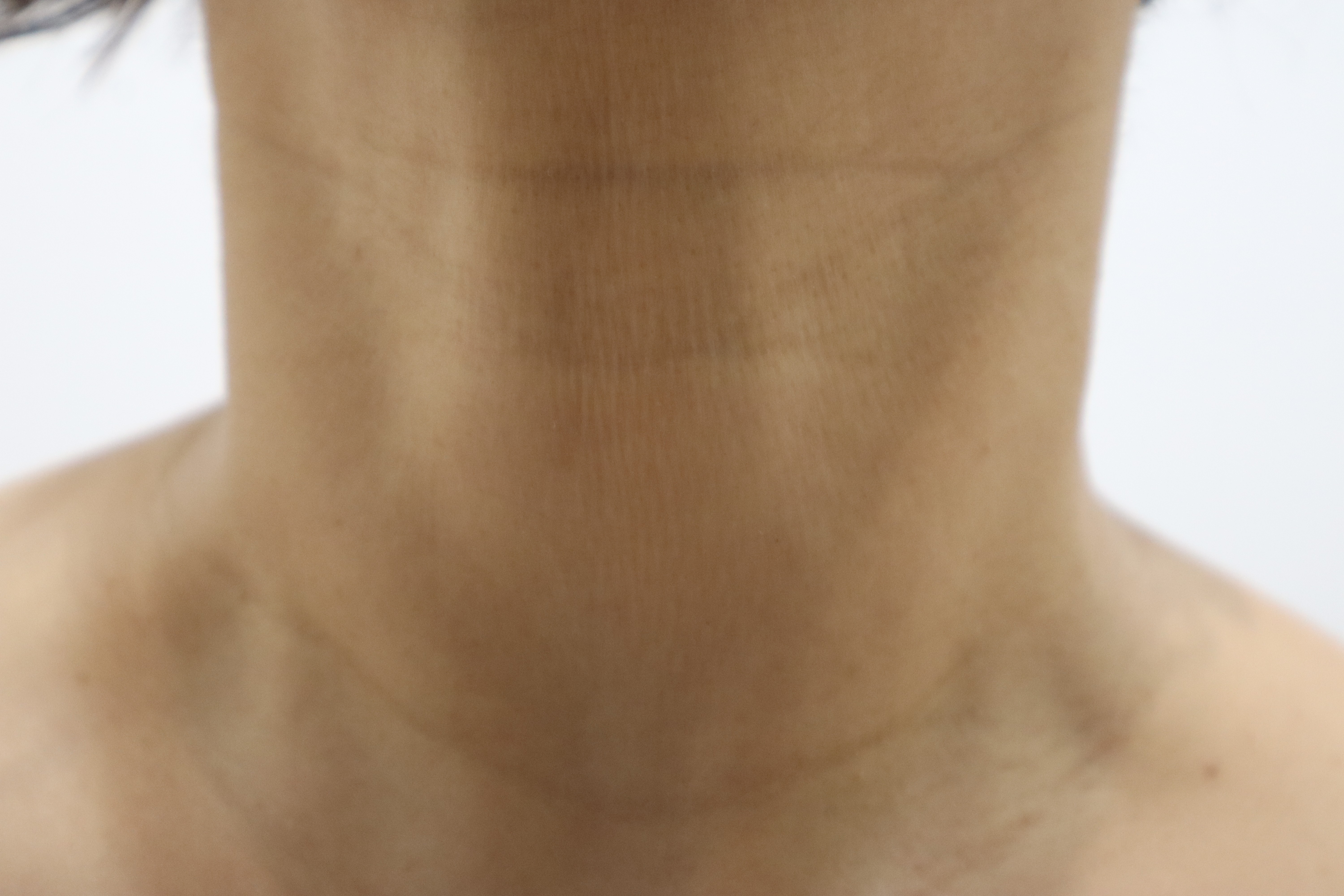 Neck-line filler with Re2O Volume: 13-day follow-up before and after at Toxnfill Hongdae
