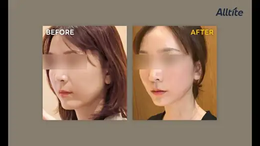 Alltite — oblique view, 15 days before and after at Toxnfill Hongdae