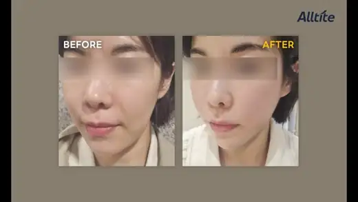 Alltite — oblique view, one month before and after at Toxnfill Hongdae