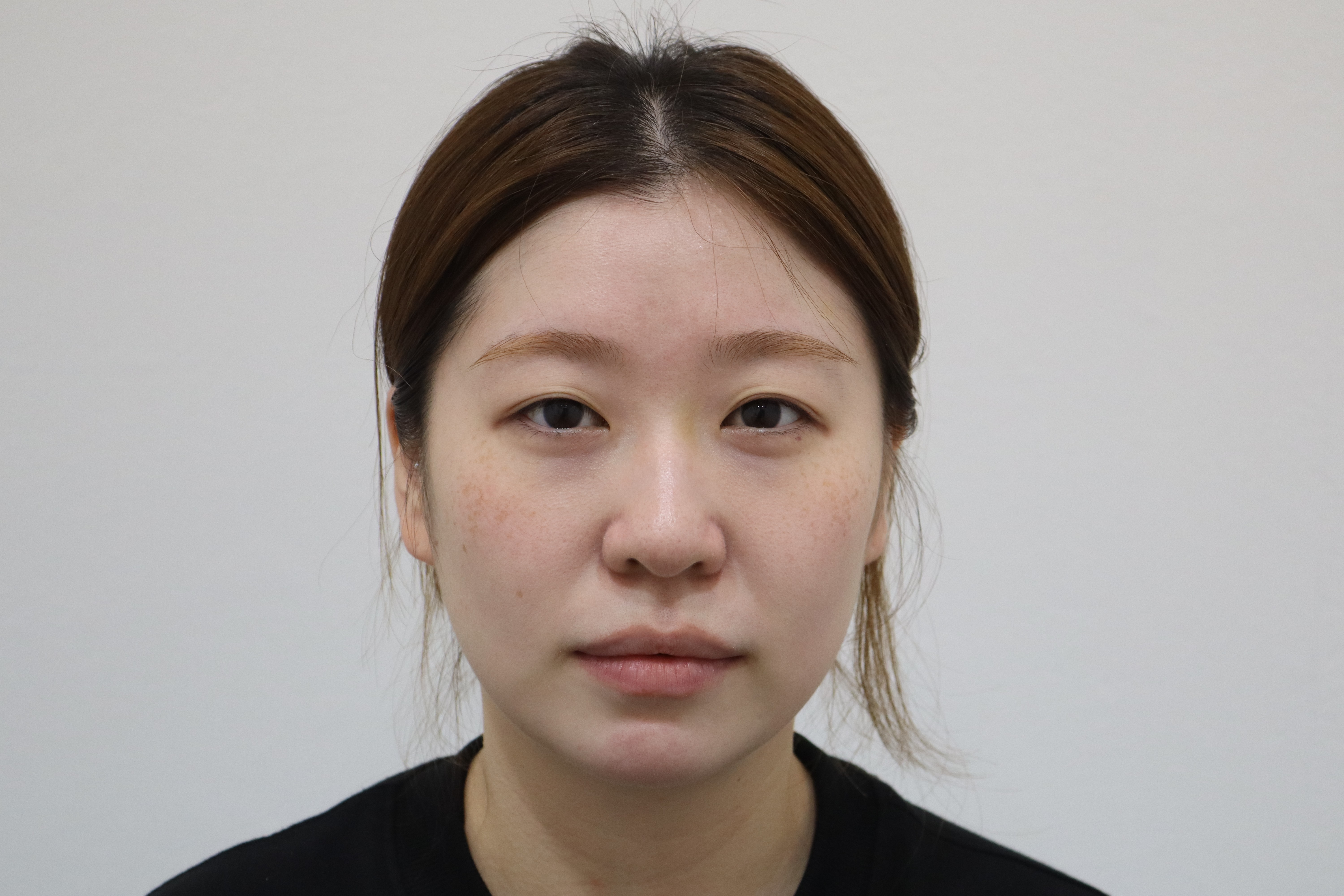 Pico pigmentation treatment: treatment day and two days later before and after at Toxnfill Hongdae