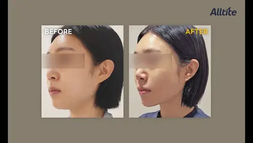 Alltite — side view, 20 days before and after at Toxnfill Hongdae