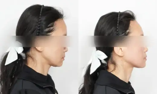 Alltite — side view, immediately after treatment before and after at Toxnfill Hongdae