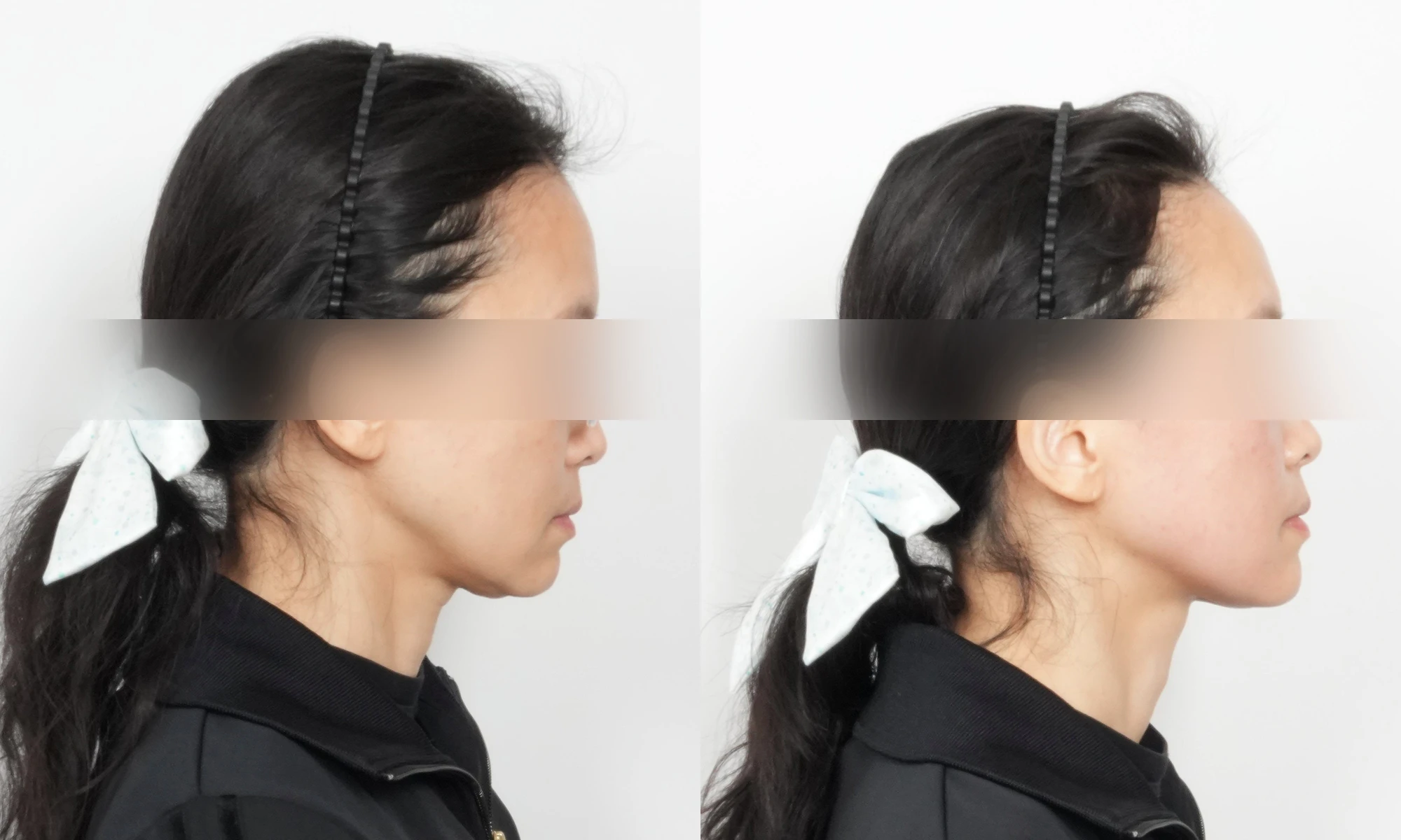 Alltite at Toxnfill Hongdae: side view, before on the left and immediately after treatment on the right