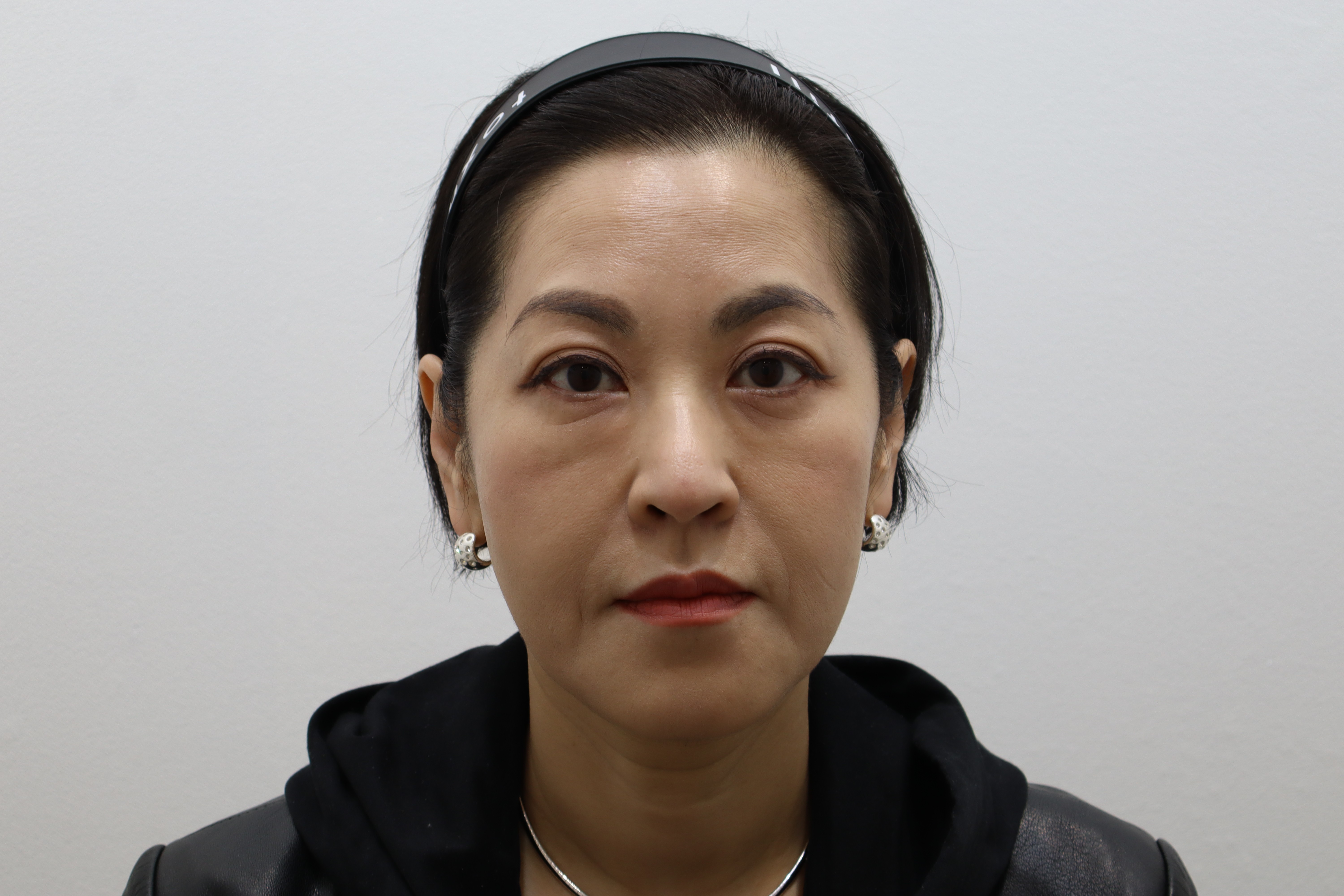 Radiesse and Re2O Volume for cheeks and nasolabial folds before and after at Toxnfill Hongdae
