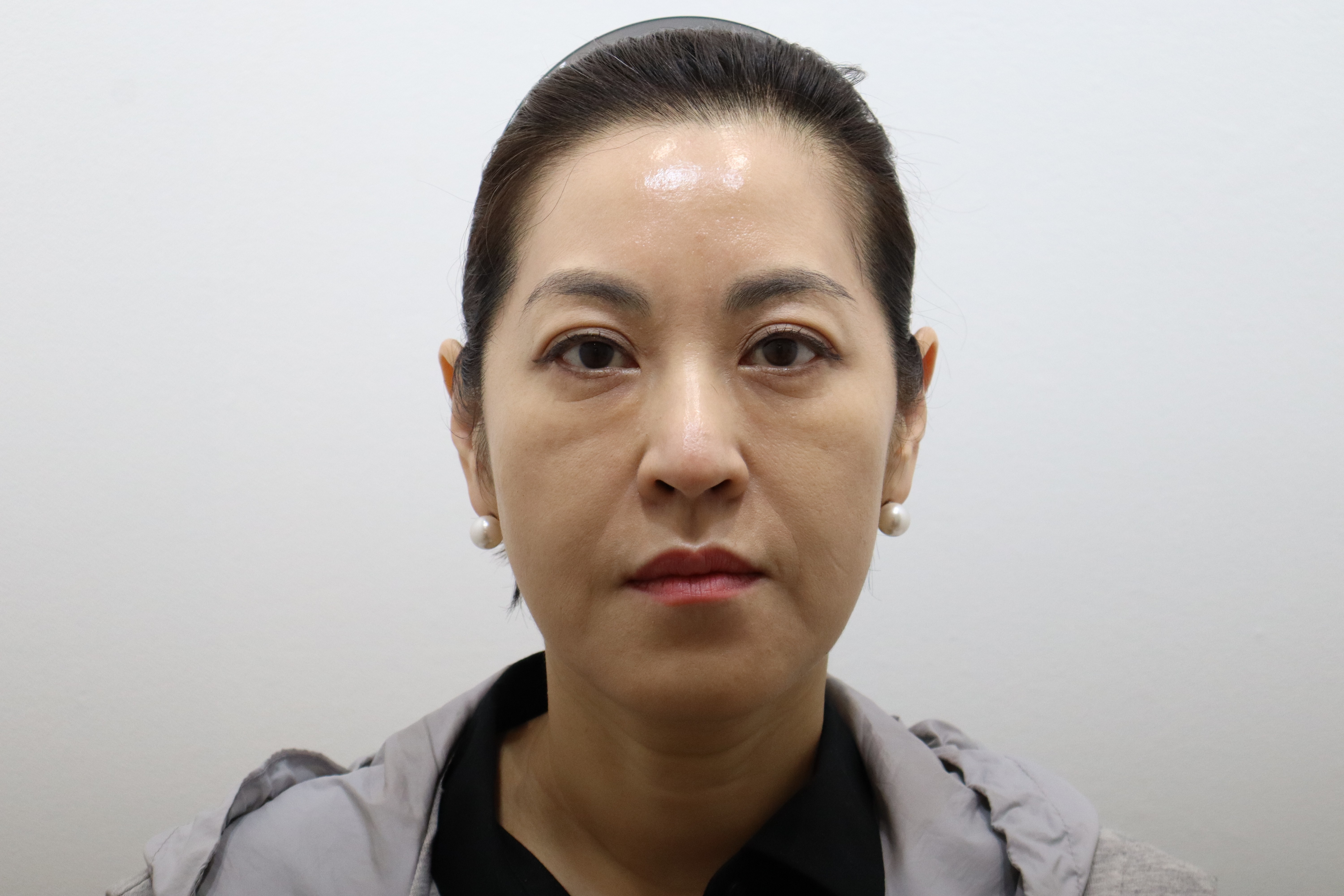 Radiesse and Re2O Volume for cheeks and nasolabial folds at Toxnfill Hongdae: follow-up, front view, May 12, 2026