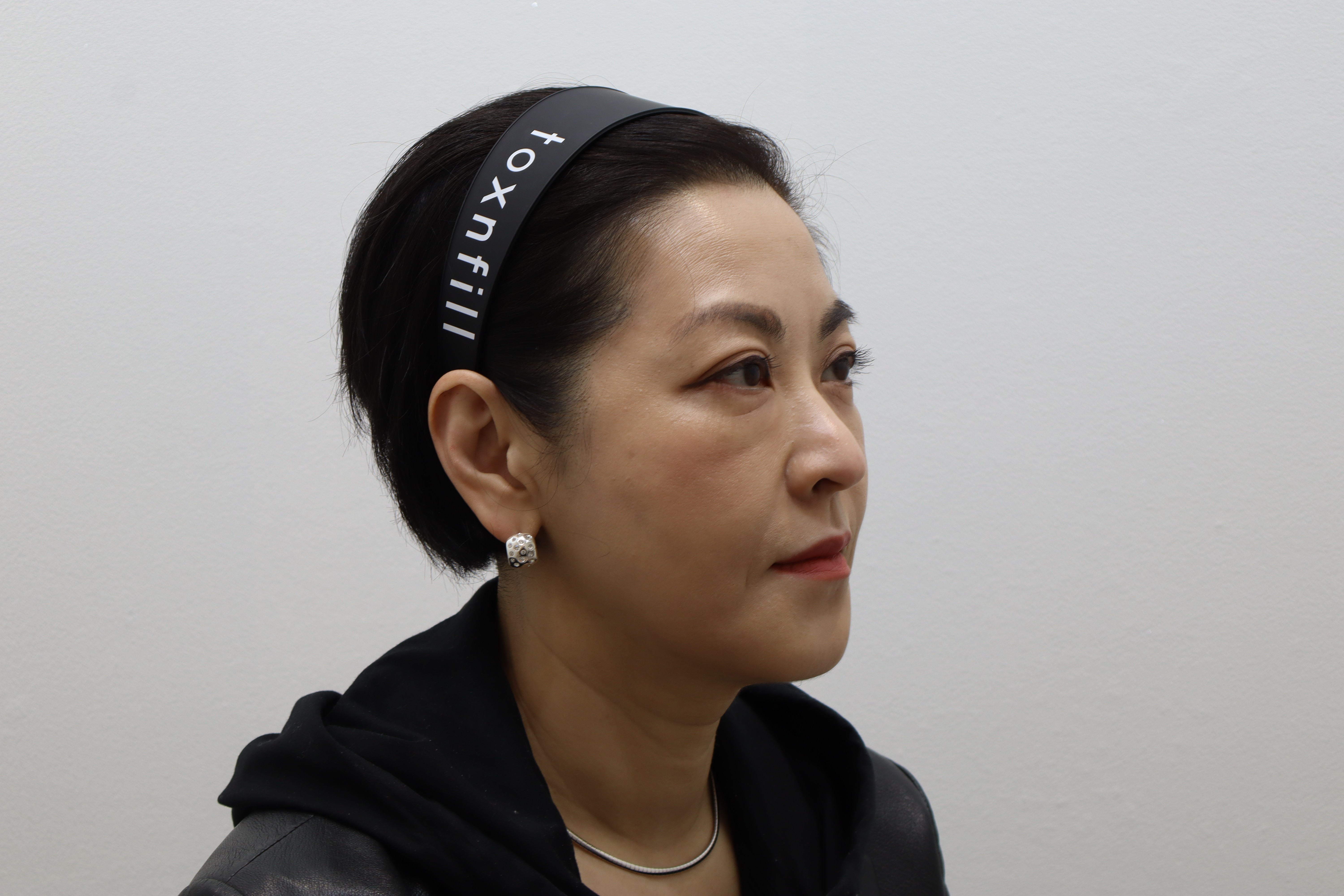 Radiesse and Re2O Volume for cheeks and nasolabial folds at Toxnfill Hongdae: before, angled view, March 17, 2026