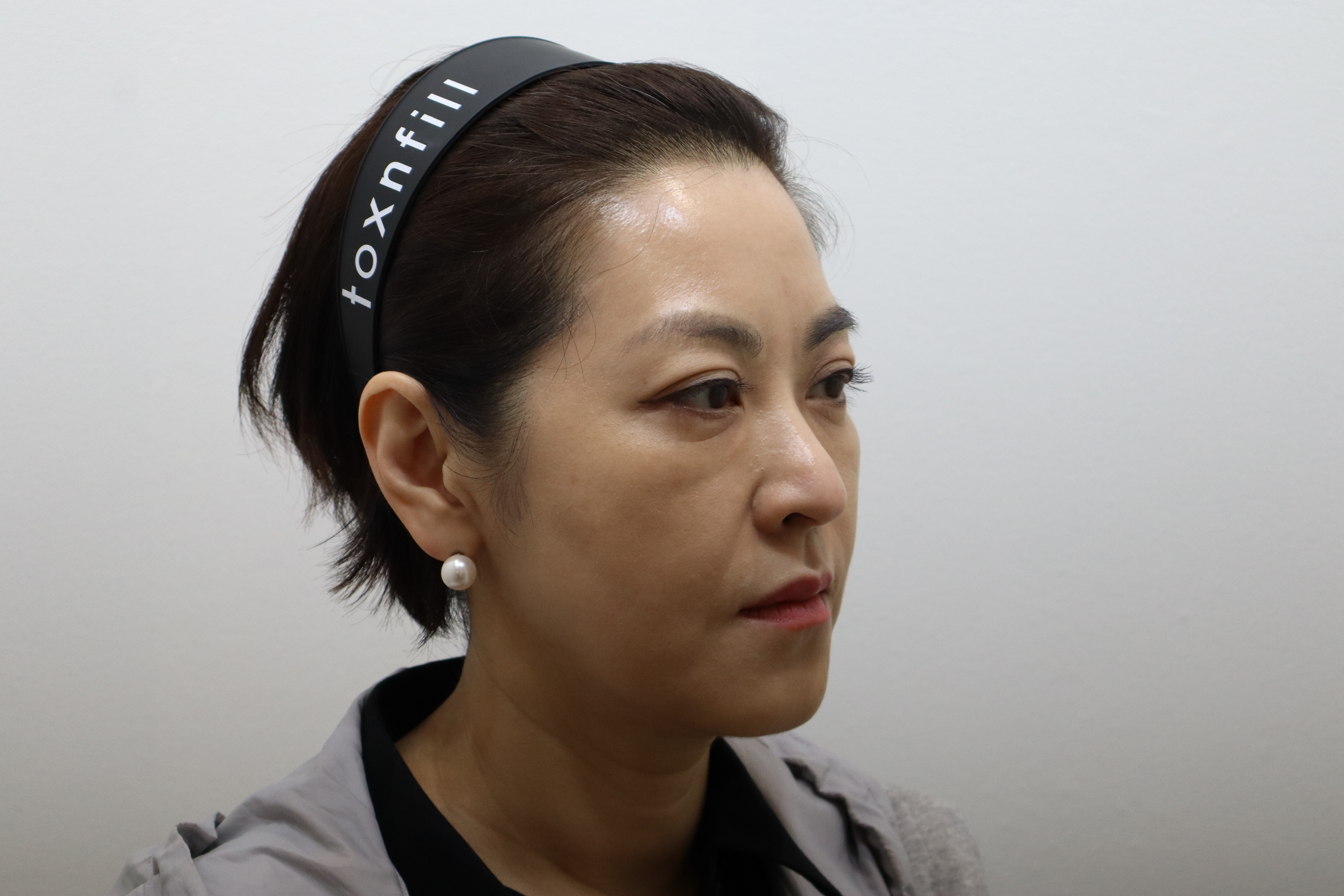 Radiesse and Re2O Volume for cheeks and nasolabial folds at Toxnfill Hongdae: follow-up, angled view, May 12, 2026