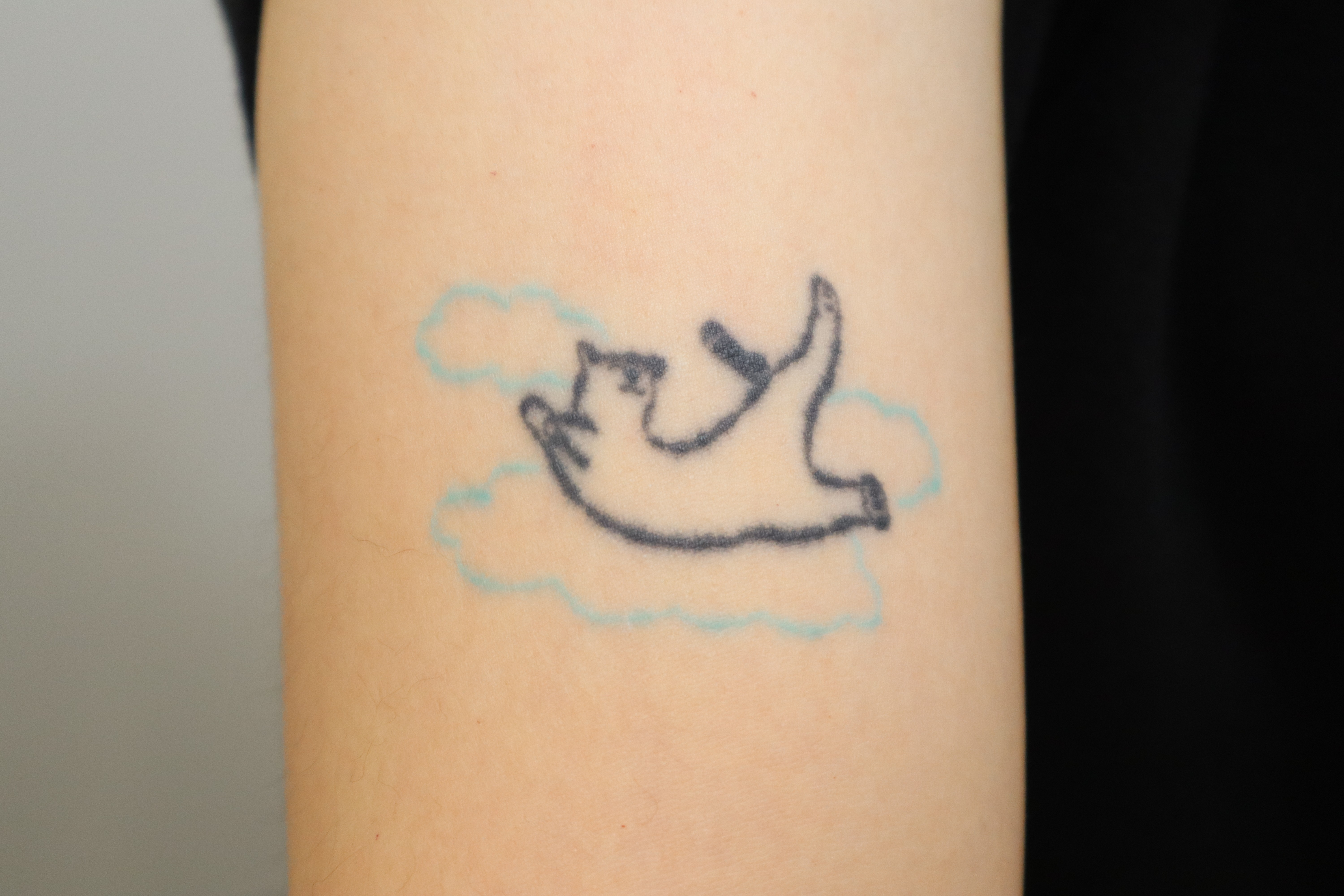 Tattoo removal: before and after treatment before and after at Toxnfill Hongdae