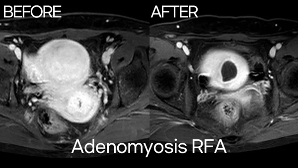 Adenomyosis RFA before and after at Trinity Women’s Clinic