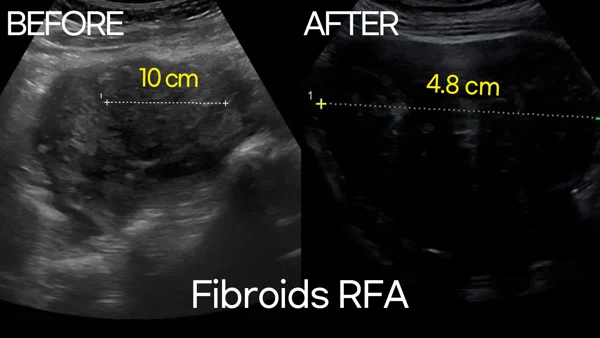 Uterine fibroid RFA before and after at Trinity Women’s Clinic