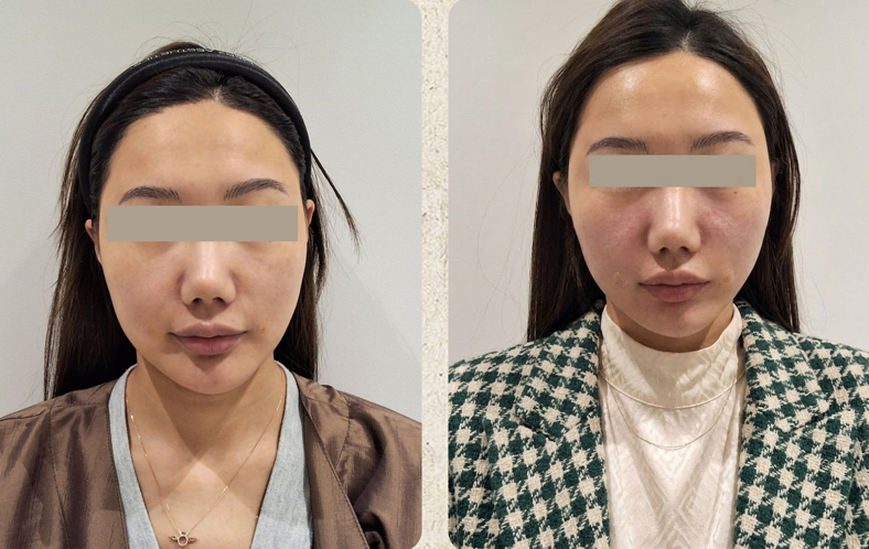 Collagen-volume facial comparison at UMI Clinic. UMI Clinic, Seoul: Collagen-volume facial comparison. Clinic-supplied comparison board; follow-up interval not supplied.