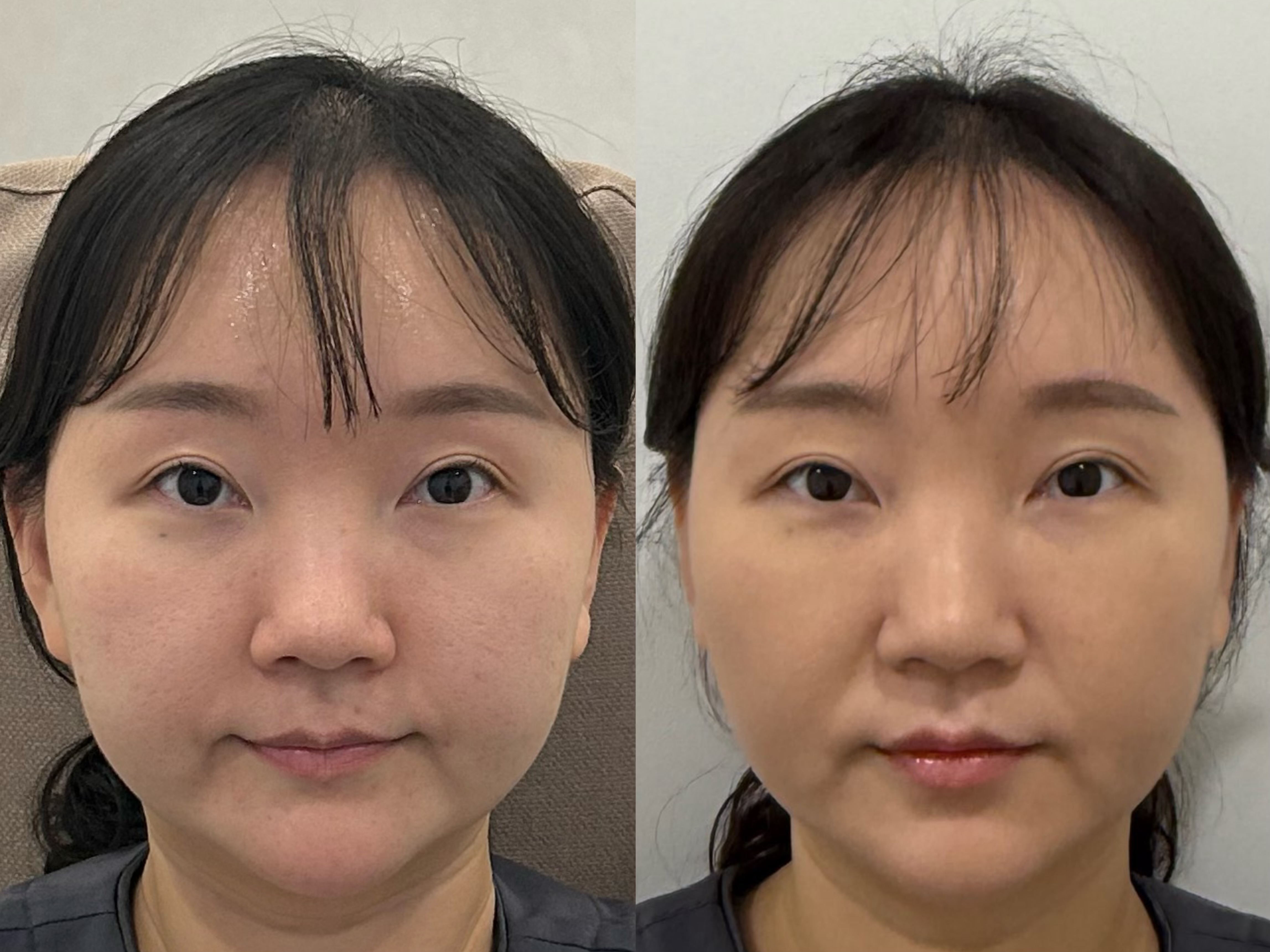 Facial lifting — five views at UMI Clinic. UMI Clinic, Seoul: Facial lifting — five views. Front view; clinic-supplied paired photographs. Follow-up interval not supplied.