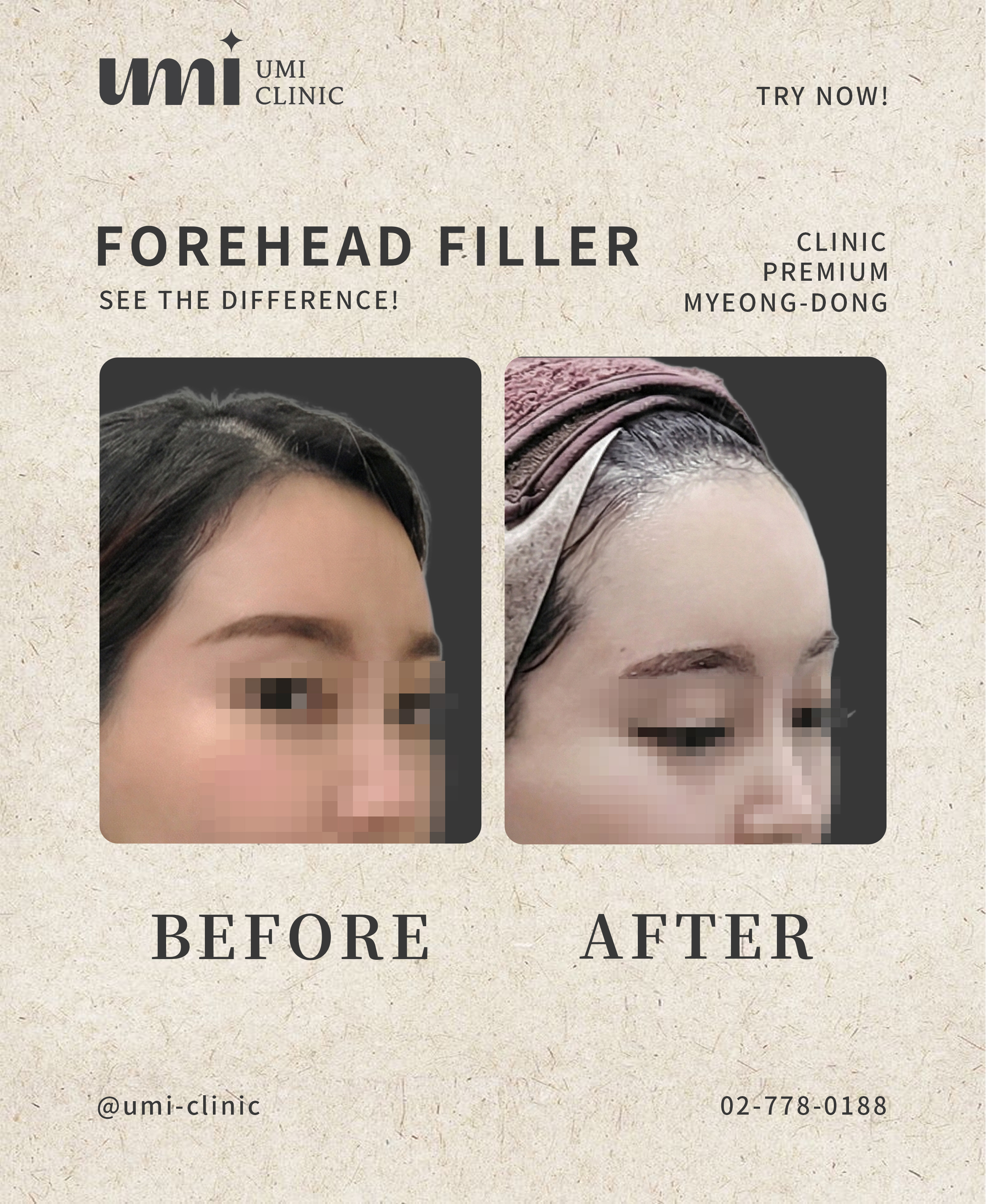 Forehead filler — angled comparison at UMI Clinic. UMI Clinic, Seoul: Forehead filler — angled comparison. Angled forehead comparison; clinic-supplied paired photographs. Follow-up interval not supplied.