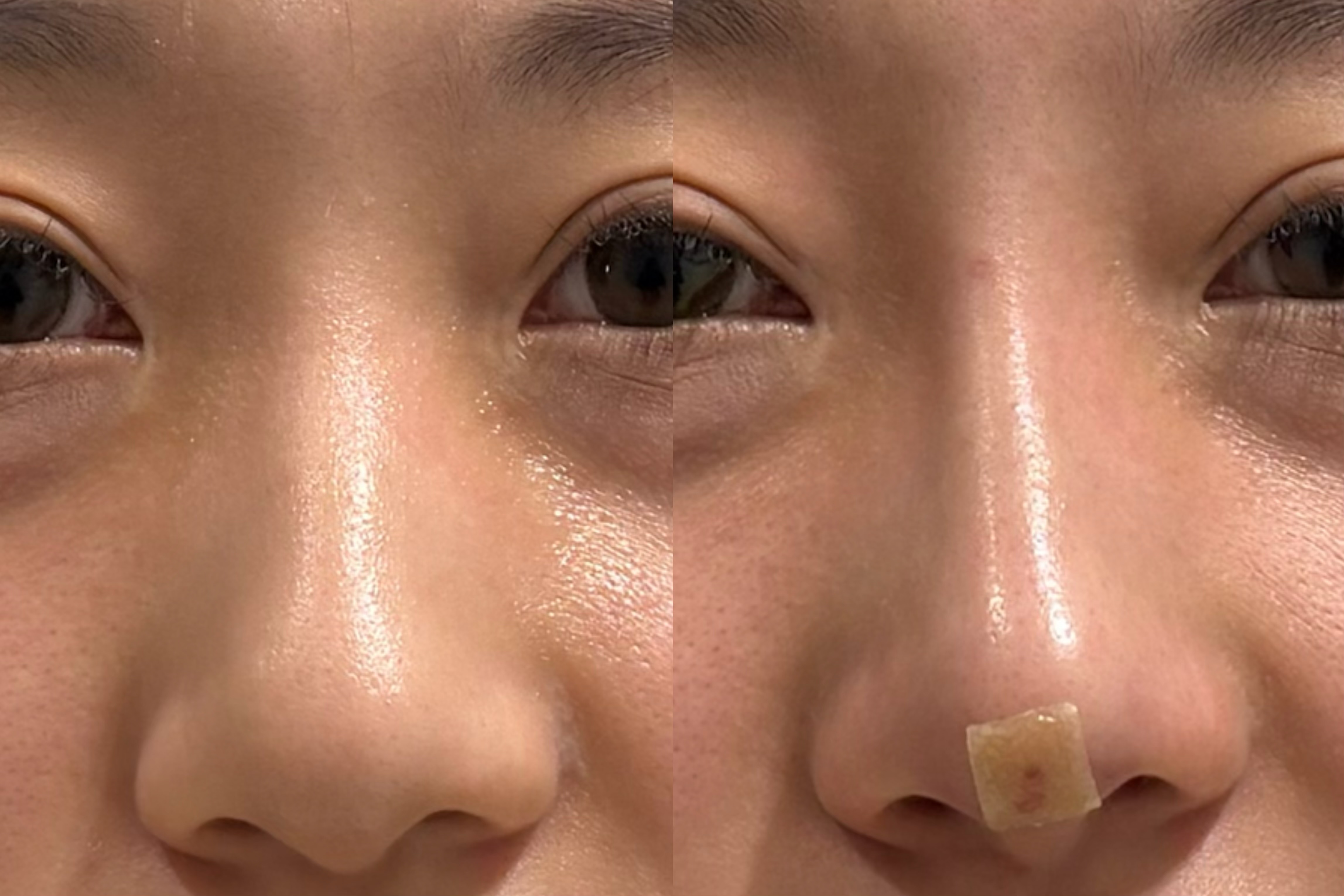Nose comparison — five close-up views at UMI Clinic. UMI Clinic, Seoul: Nose comparison — five close-up views. Front close-up; clinic-supplied paired photographs. Follow-up interval not supplied.
