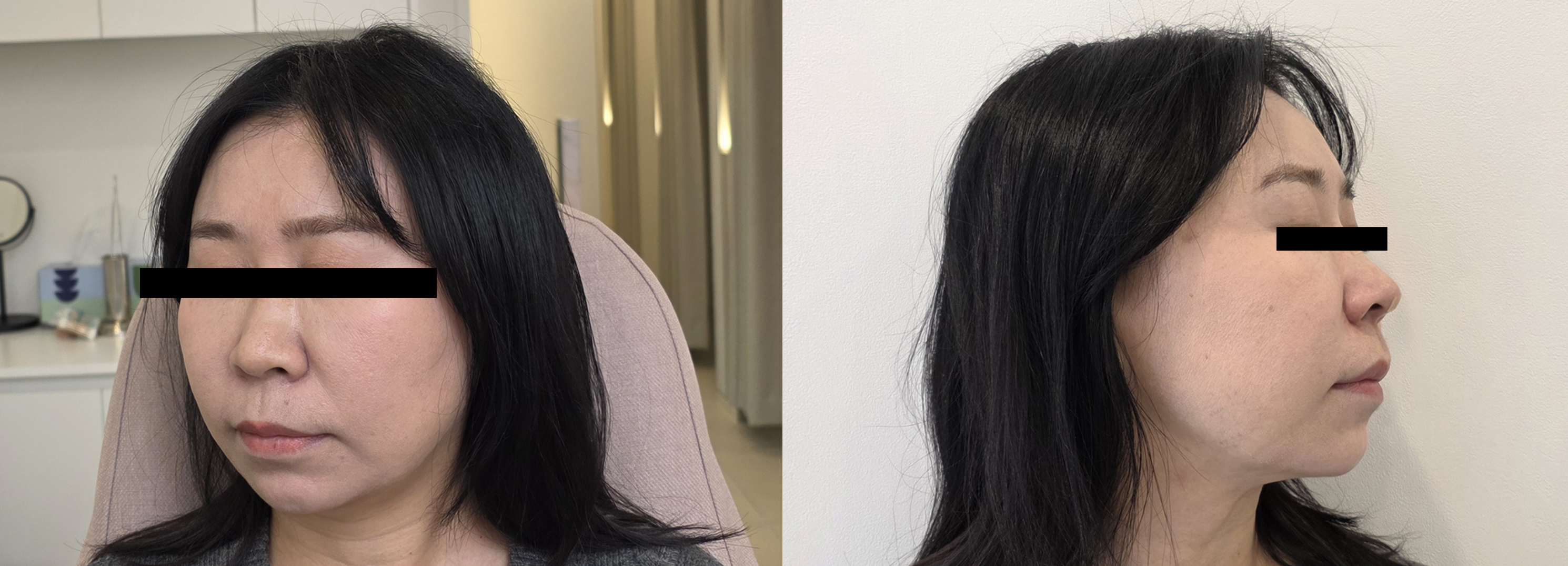 Nose filler — frontal and profile views at UMI Clinic. UMI Clinic, Seoul: Nose filler — frontal and profile views. Clinic-supplied comparison board; follow-up interval not supplied.