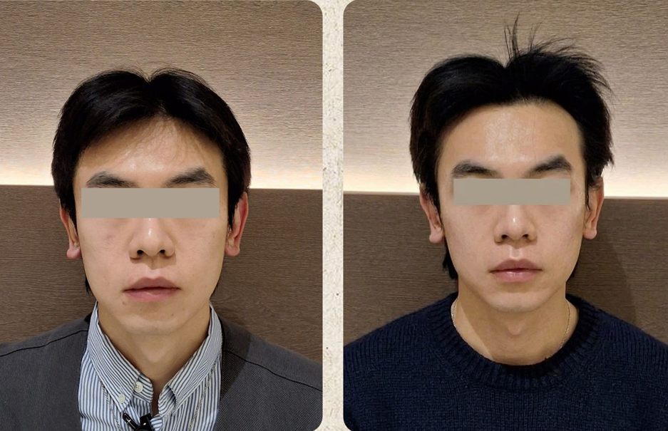 Skin booster — facial comparison at UMI Clinic. UMI Clinic, Seoul: Skin booster — facial comparison. Clinic-supplied comparison board; follow-up interval not supplied.