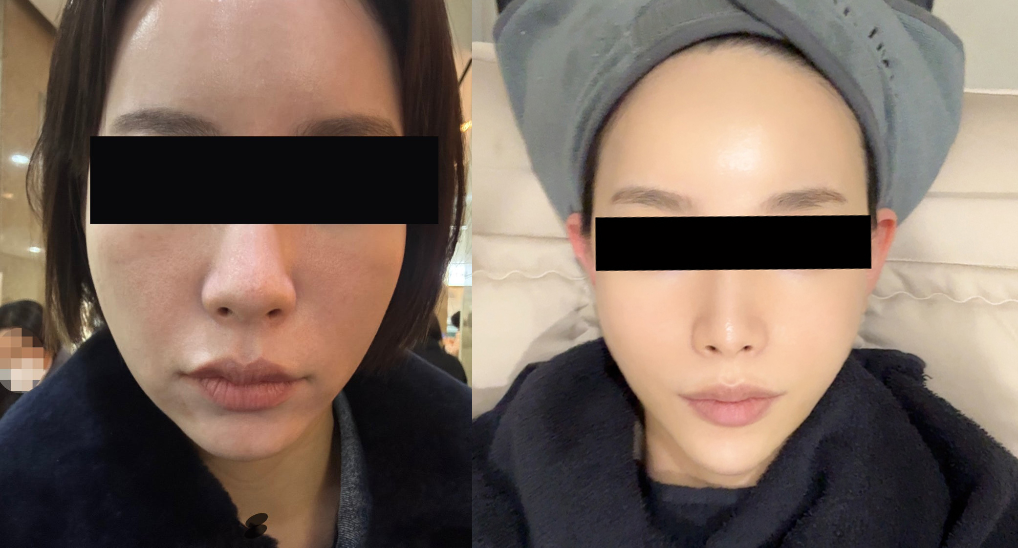 Thermage — facial comparison at UMI Clinic. UMI Clinic, Seoul: Thermage — facial comparison. Clinic-supplied comparison board; follow-up interval not supplied.