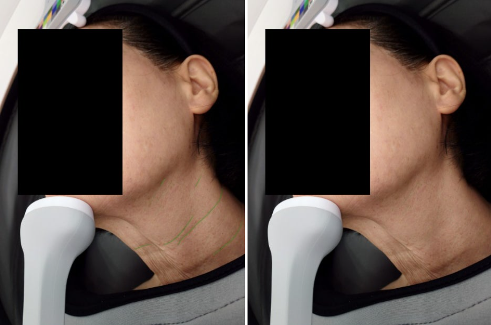 Titanium combination for neck lines at UMI Clinic. UMI Clinic, Seoul: Titanium combination for neck lines. Clinic-supplied comparison board; follow-up interval not supplied.