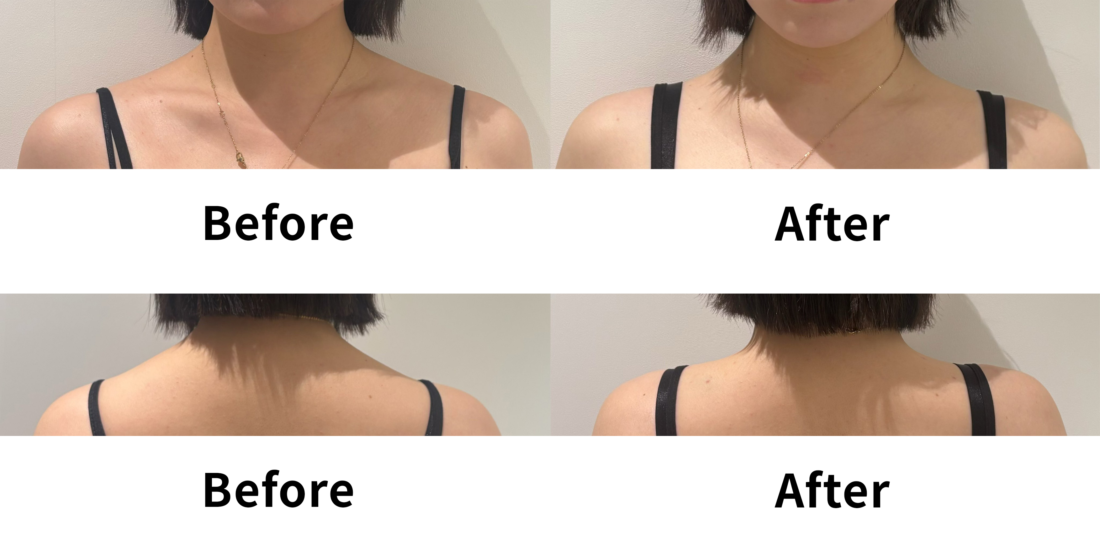 Trapezius botulinum toxin — shoulder comparison at UMI Clinic. UMI Clinic, Seoul: Trapezius botulinum toxin — shoulder comparison. Clinic-supplied comparison board; follow-up interval not supplied.