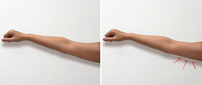 Upper-arm Onda comparison at UMI Clinic. UMI Clinic, Seoul: Upper-arm Onda comparison. Clinic-supplied comparison board; follow-up interval not supplied.