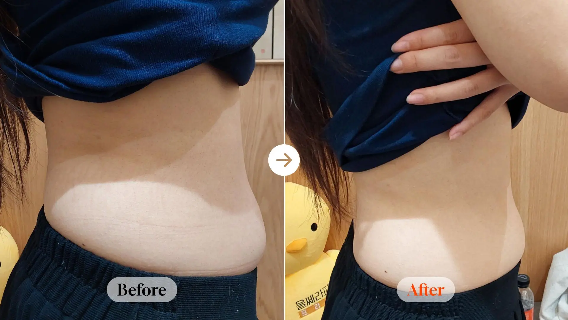 Body ONDA 80 kJ: left and right side views at Velicell Clinic. Velicell Clinic — Body ONDA 80 kJ: left and right side views. Right-side body view. Before on the left and after on the right; follow-up timing not supplied.