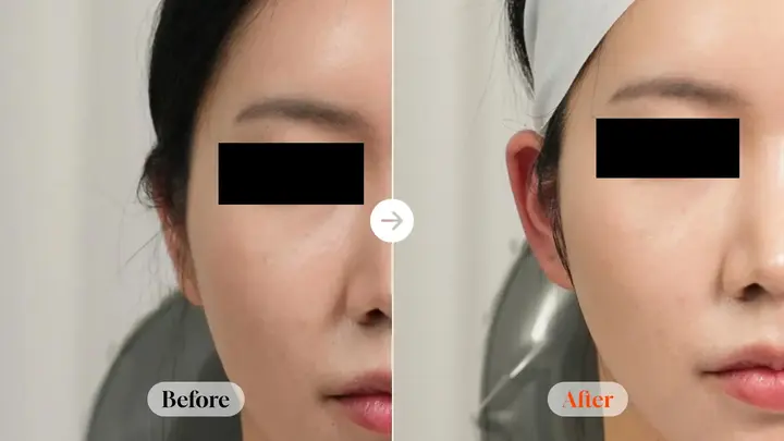 Ear filler: the outer-ear outline at Velicell Clinic. Velicell Clinic — Ear filler: the outer-ear outline. Before on the left and after on the right; follow-up timing not supplied.