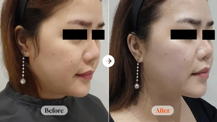 ONDA 60 kJ: angled facial views at Velicell Clinic. Velicell Clinic — ONDA 60 kJ: angled facial views. Before on the left and after on the right; follow-up timing not supplied.