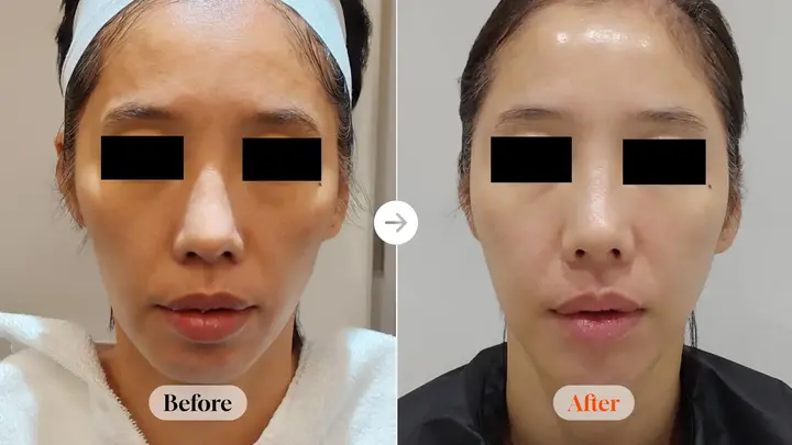 Re2O, Hilo Wave, Juvelook Volume and Potenza at Velicell Clinic. Velicell Clinic — Re2O, Hilo Wave, Juvelook Volume and Potenza. Before on the left and after on the right; follow-up timing not supplied.