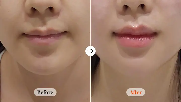 Restylane Kysse lip filler: 1 cc comparison at Velicell Clinic. Velicell Clinic — Restylane Kysse lip filler: 1 cc comparison. Before on the left and after on the right; follow-up timing not supplied.