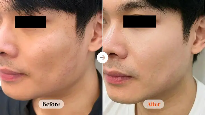 Rejuran 2 cc: cheek close-up at Velicell Clinic. Velicell Clinic — Rejuran 2 cc: cheek close-up. Before on the left and after on the right; follow-up timing not supplied.