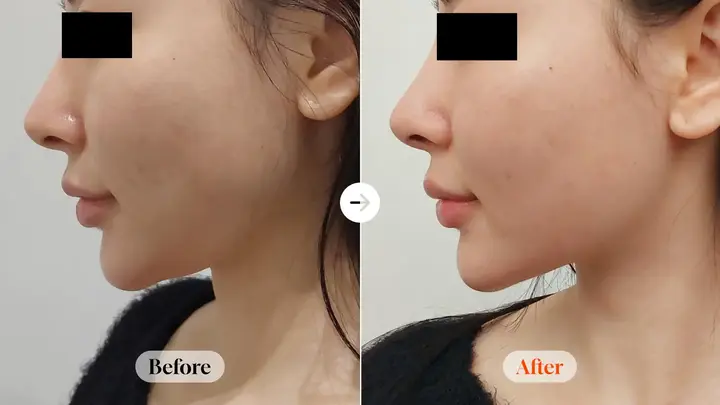 ONDA 60 kJ: side-profile comparison at Velicell Clinic. Velicell Clinic — ONDA 60 kJ: side-profile comparison. Before on the left and after on the right; follow-up timing not supplied.