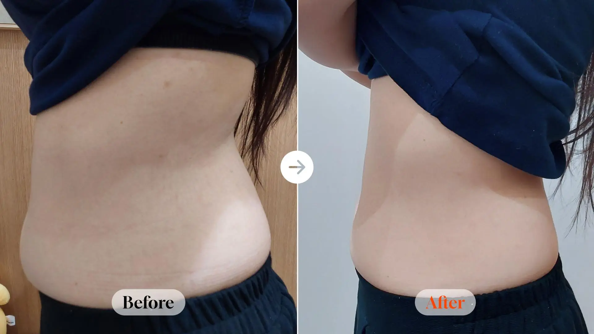 Body ONDA 80 kJ: left and right side views at Velicell Clinic. Velicell Clinic — Body ONDA 80 kJ: left and right side views. Left-side body view. Before on the left and after on the right; follow-up timing not supplied.