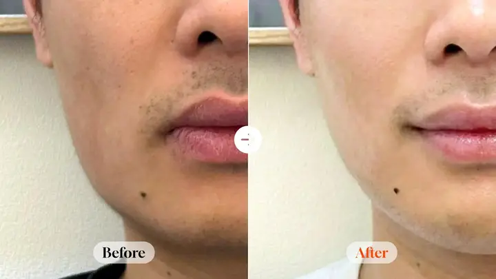 Jaw Botox: lower-face close-up at Velicell Clinic. Velicell Clinic — Jaw Botox: lower-face close-up. Before on the left and after on the right; follow-up timing not supplied.