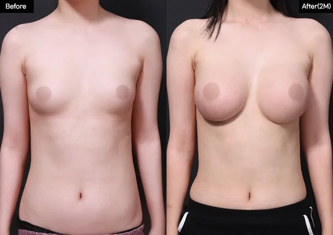 Breast augmentation — front view, 2 months · 01 before and after at Verygood Plastic Surgery