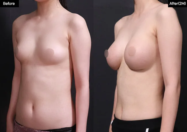Breast augmentation — angled view, 2 months · 02 before and after at Verygood Plastic Surgery