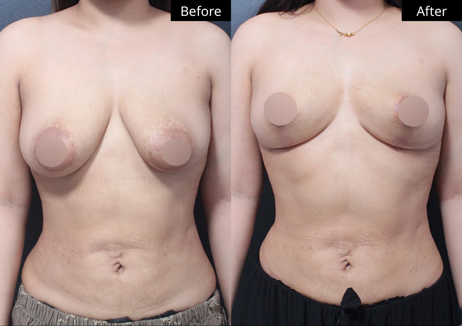 Verygood Plastic Surgery: Breast lift and reduction — front view · 10. Before on the left; after on the right.